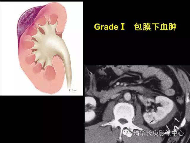 肾脏损伤分级 肾脏损伤分级