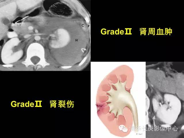 肾脏损伤分级 肾脏损伤分级