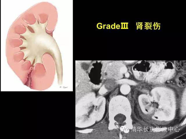 肾脏损伤分级 肾脏损伤分级