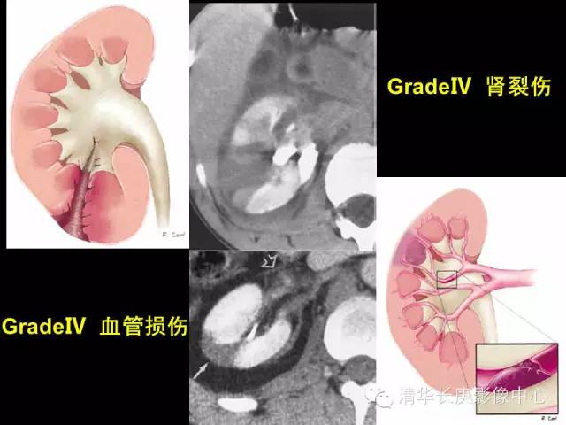肾脏损伤分级 肾脏损伤分级