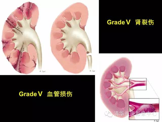 肾脏损伤分级 肾脏损伤分级