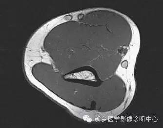 肘关节横断位-矢状位-冠状位解剖+详细标注