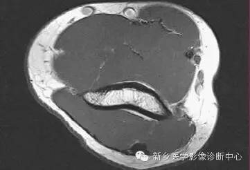 肘关节横断位-矢状位-冠状位解剖+详细标注