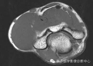 肘关节横断位-矢状位-冠状位解剖+详细标注