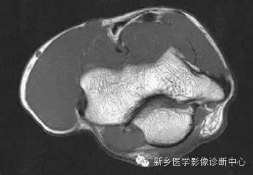 肘关节横断位-矢状位-冠状位解剖+详细标注