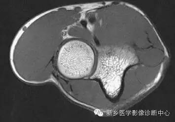 肘关节横断位-矢状位-冠状位解剖+详细标注