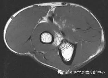肘关节横断位-矢状位-冠状位解剖+详细标注