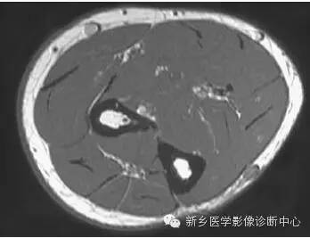 肘关节横断位-矢状位-冠状位解剖+详细标注