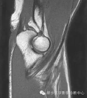 肘关节横断位-矢状位-冠状位解剖+详细标注
