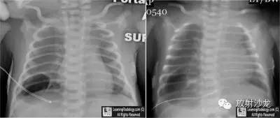 【病例】先天性囊性腺瘤样畸形1例X线CT影像表现
