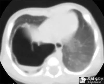 【病例】先天性囊性腺瘤样畸形1例X线CT影像表现