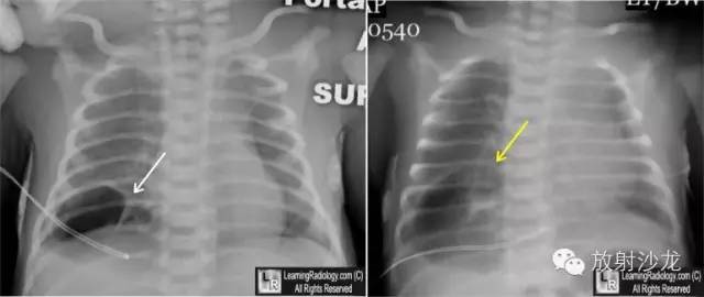 【病例】先天性囊性腺瘤样畸形1例X线CT影像表现