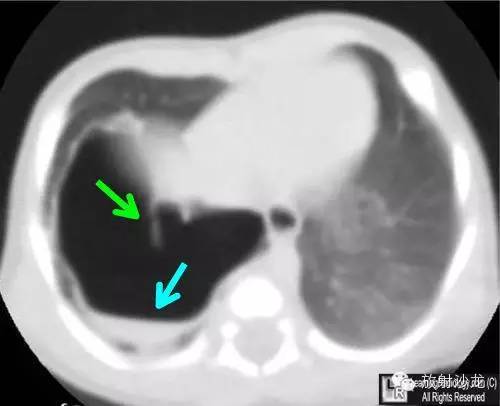 【病例】先天性囊性腺瘤样畸形1例X线CT影像表现