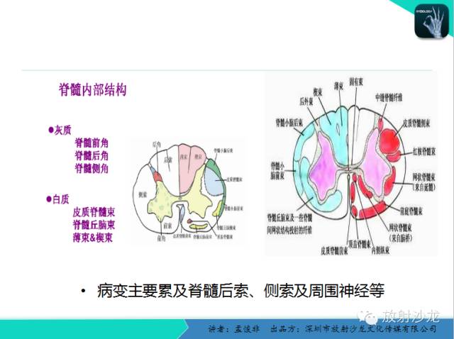 【PPT】脊髓亚急性联合变性