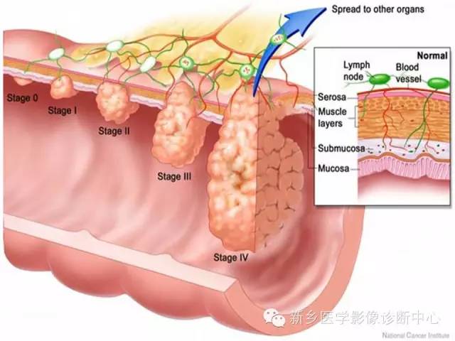 【PPT】直肠癌的MR检查方法及诊断