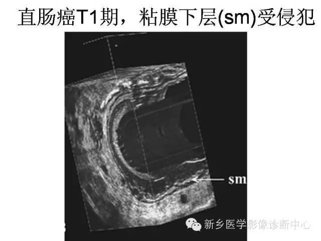 【PPT】直肠癌的MR检查方法及诊断