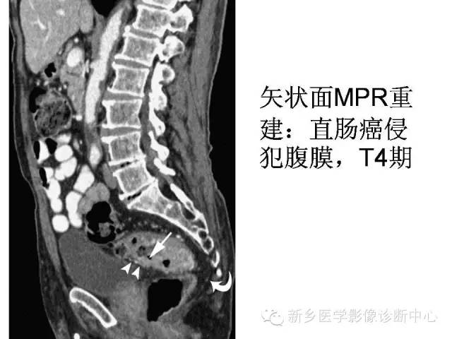 【PPT】直肠癌的MR检查方法及诊断