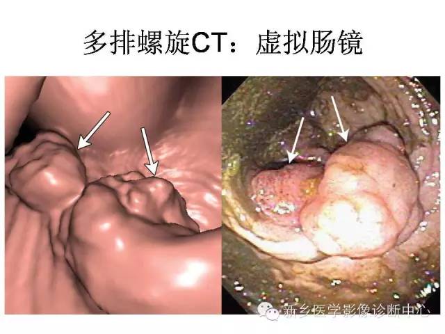 【PPT】直肠癌的MR检查方法及诊断