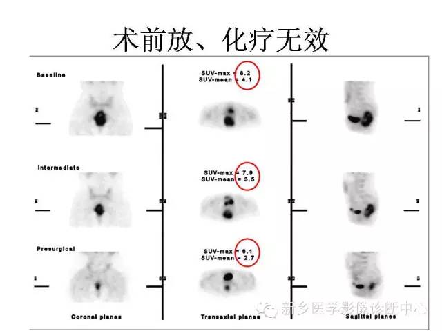 【PPT】直肠癌的MR检查方法及诊断