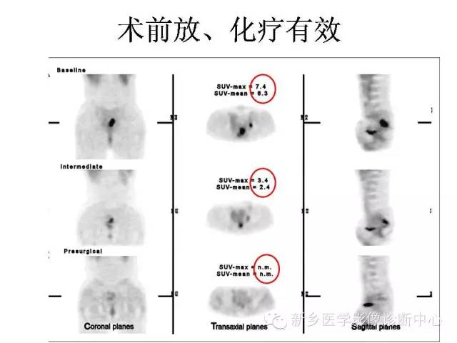【PPT】直肠癌的MR检查方法及诊断