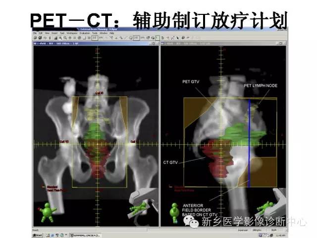 【PPT】直肠癌的MR检查方法及诊断