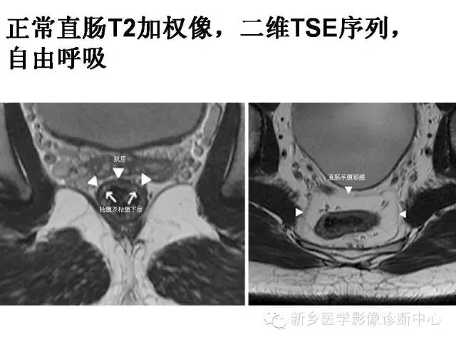【PPT】直肠癌的MR检查方法及诊断