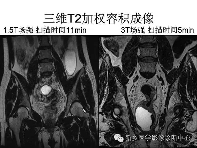 【PPT】直肠癌的MR检查方法及诊断