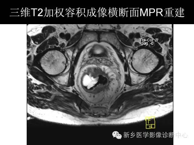 【PPT】直肠癌的MR检查方法及诊断