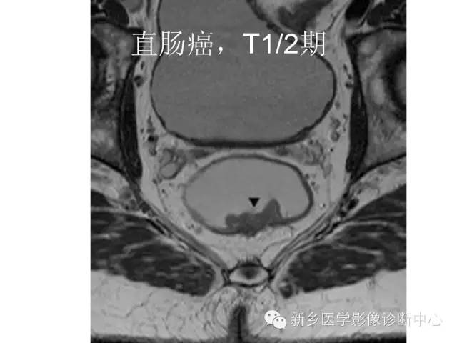 【PPT】直肠癌的MR检查方法及诊断