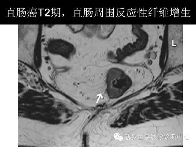 【PPT】直肠癌的MR检查方法及诊断