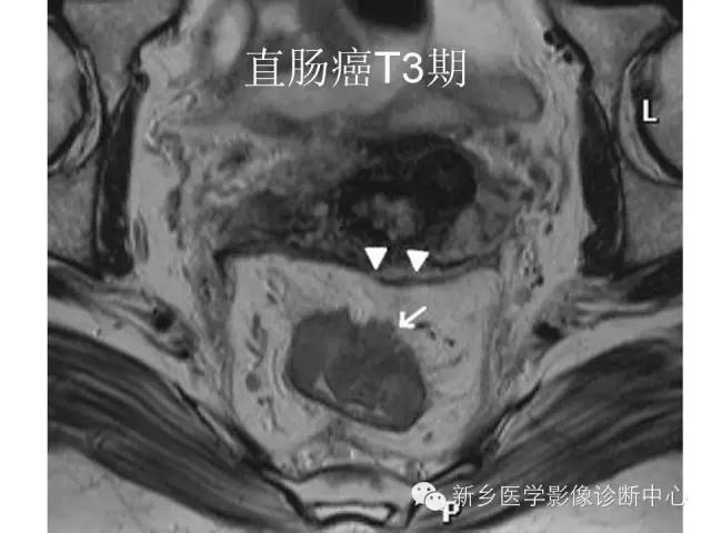【PPT】直肠癌的MR检查方法及诊断