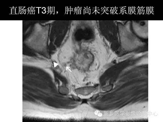【PPT】直肠癌的MR检查方法及诊断