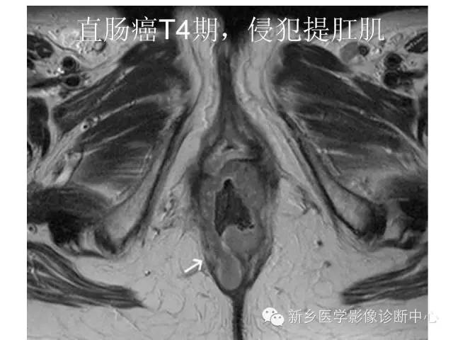 【PPT】直肠癌的MR检查方法及诊断