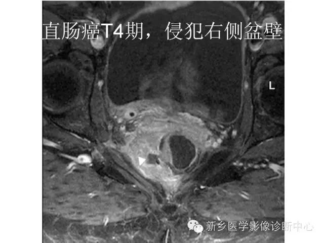 【PPT】直肠癌的MR检查方法及诊断