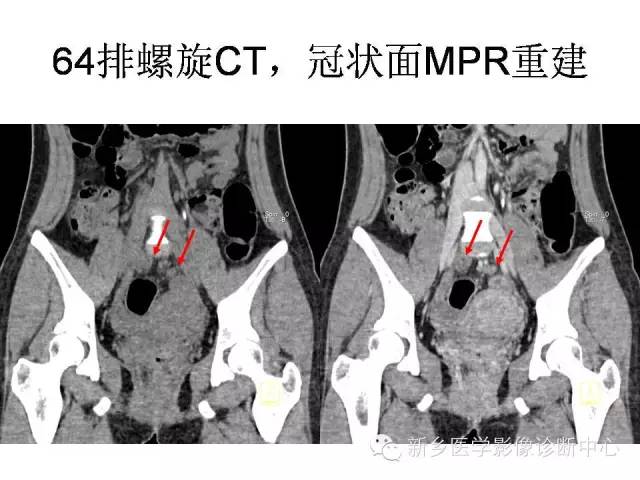 【PPT】直肠癌的MR检查方法及诊断