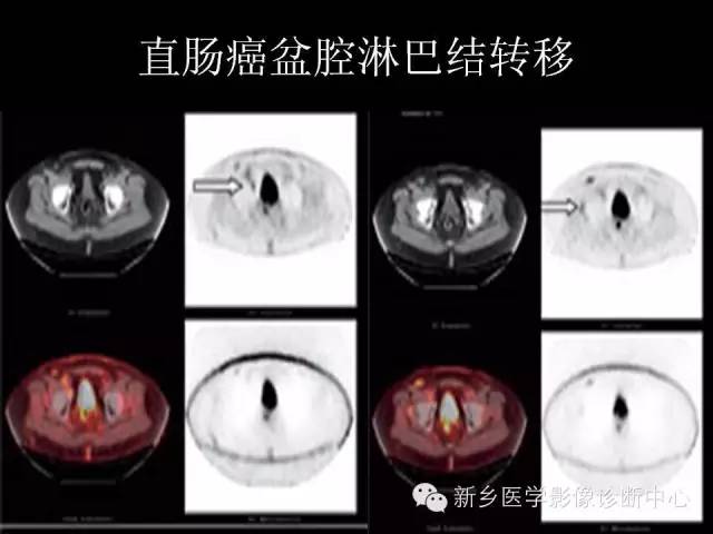 【PPT】直肠癌的MR检查方法及诊断