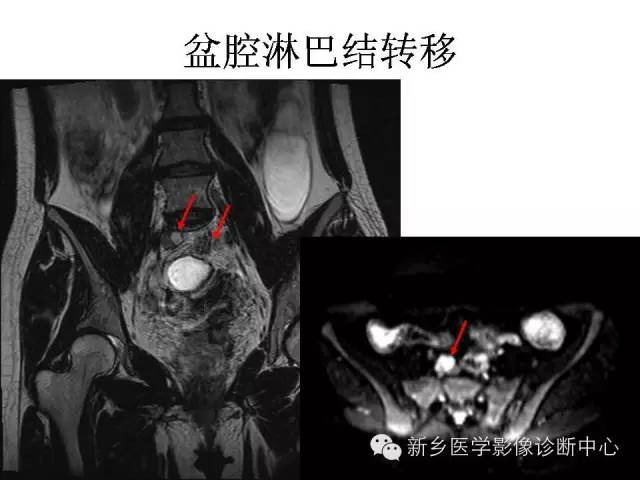 【PPT】直肠癌的MR检查方法及诊断