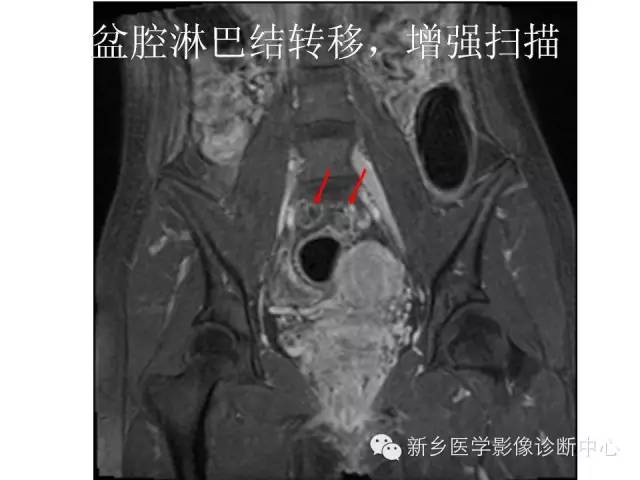 【PPT】直肠癌的MR检查方法及诊断