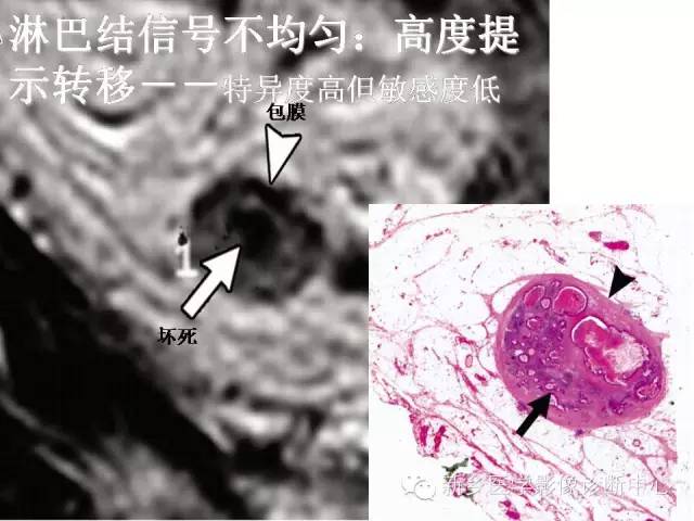 【PPT】直肠癌的MR检查方法及诊断