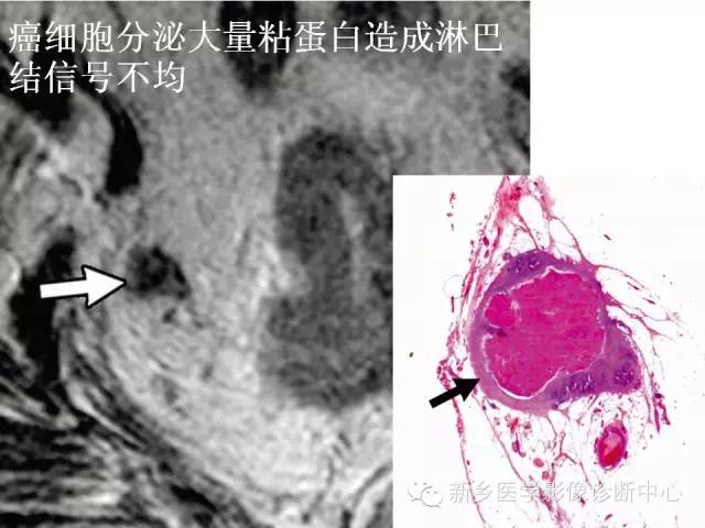 【PPT】直肠癌的MR检查方法及诊断