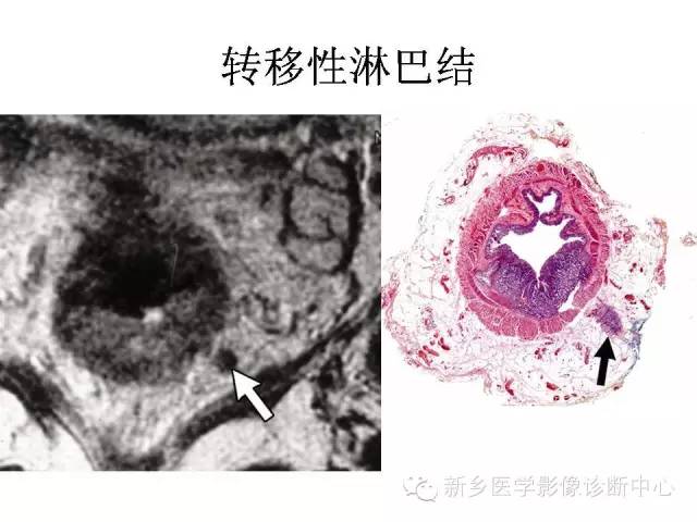 【PPT】直肠癌的MR检查方法及诊断