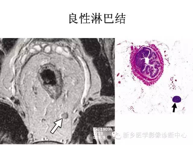 【PPT】直肠癌的MR检查方法及诊断