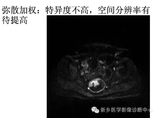 【PPT】直肠癌的MR检查方法及诊断