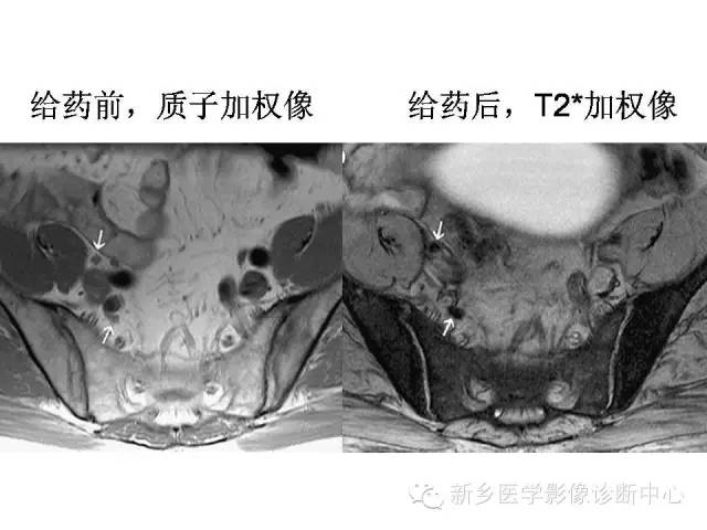 【PPT】直肠癌的MR检查方法及诊断