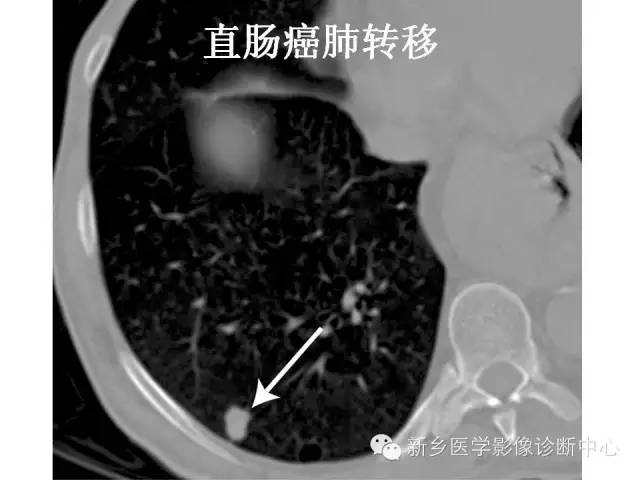 【PPT】直肠癌的MR检查方法及诊断