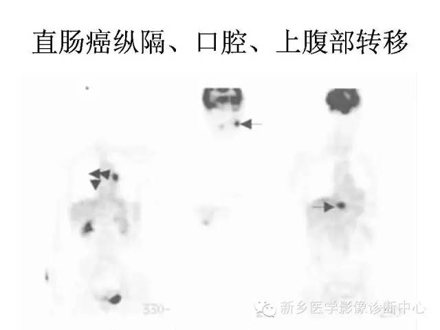 【PPT】直肠癌的MR检查方法及诊断