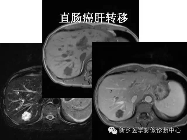 【PPT】直肠癌的MR检查方法及诊断