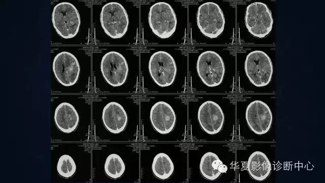 【病例】多形性胶质母细胞瘤1例MR影像表现