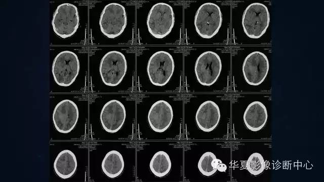【病例】多形性胶质母细胞瘤1例MR影像表现
