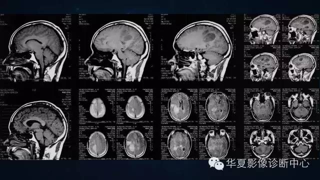 【病例】多形性胶质母细胞瘤1例MR影像表现